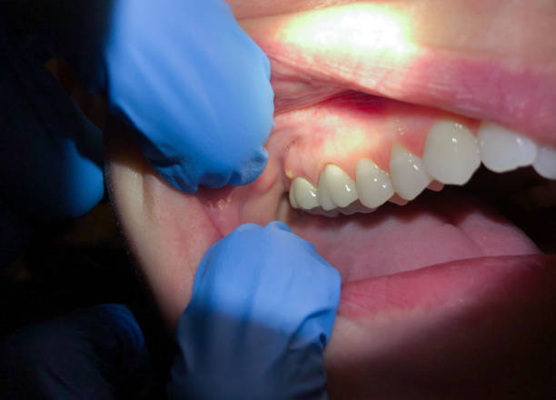 Best Emergency Broken Tooth Repair in Rushvle, IL